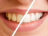 Qual a diferença no clareamento a Laser e clareamento caseiro?