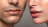 Microagulhamento Facial e Labial